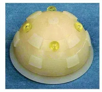 صورة توضيحية لـ استبدال مفصل الورك الكلي بالإسمنت الطبي: حل ناجح وموثوق لاستعادة الحركة