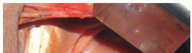 Illustration 28 for Restore Shoulder Function with Latissimus Dorsi Tendon Transfer