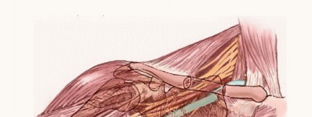 Illustration of axillary space exploration - Dr. Mohammed Hutaif