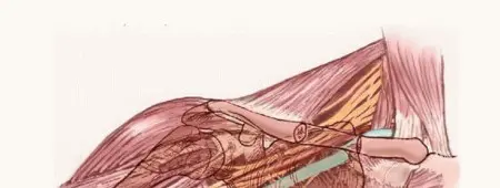 صورة توضيحية لـ استكشاف واستئصال أورام الإبط المعقدة: دليل شامل للمرضى