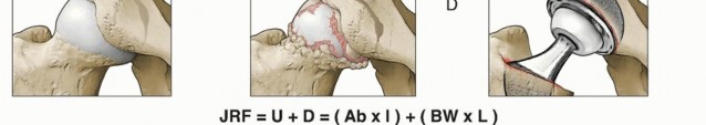Illustration 4 for Which Bearing Surface Options Are Best for Your Total Hip?