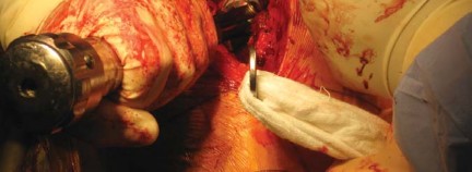 Illustration 34 for Metal on Metal Resurfacing: Enhanced Posterior Soft Tissue Repair