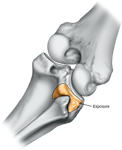Figure 8: Incision marking on the posterolateral aspect of the knee.