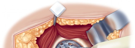 Illustration 58 for Direct Lateral Hip: Optimize Exposure with Sharp Curved Hohmann