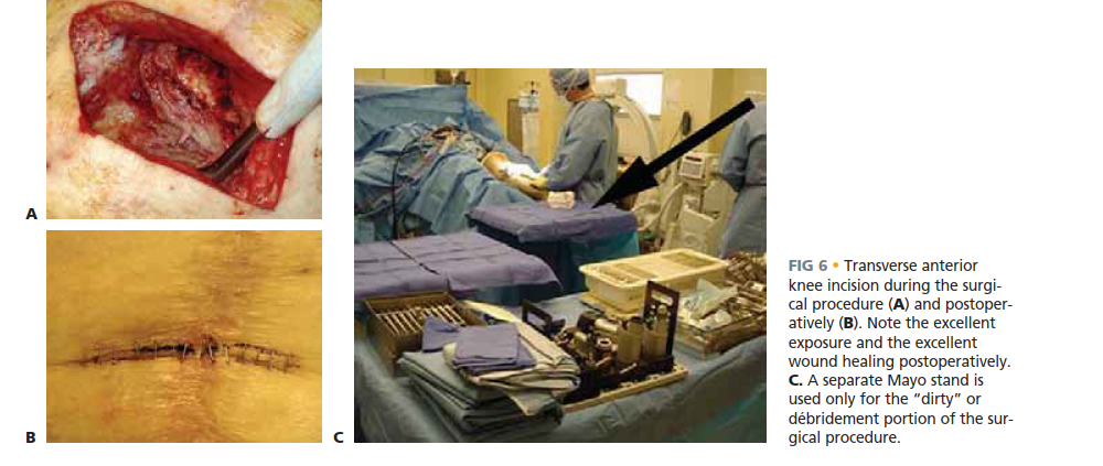 Illustration 10 for Knee Arthrodesis: A Lifelong Knee Solution for Trauma & TKA