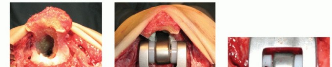 Illustration 32 for Distal Humeral Fractures: When Is Elbow Replacement the Best Option?