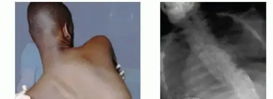 انحراف العمود الفقري العصبي العضلي: الأسباب، الأعراض، والعلاج الشامل