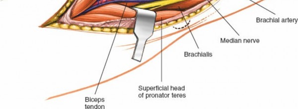 Illustration 81 for Mastering Elbow Approaches: Applied Surgical Anatomy for Precision