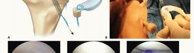 Illustration 27 for Symptomatic Knee? Meniscal Transplant for Anterior & Posterior Horns