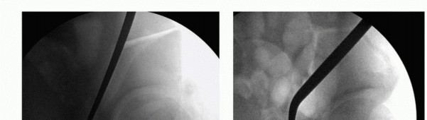 صورة توضيحية لـ جراحة قطع العظم حول الحُق وقطع عظم الفخذ: إعادة محاذاة مفصل الورك لراحة دائمة مع الأستاذ الدكتور محمد هطيف