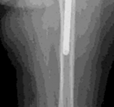 Illustration 4 for Mastering Severe Bone Loss: Highly Porous Metal for Revision THA