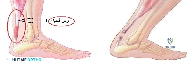 التهاب الوتر العقبي  Achilles tendinitis