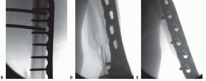 Illustration 57 for Repairing Distal Femur Fractures: Open Reduction & Internal Fixation
