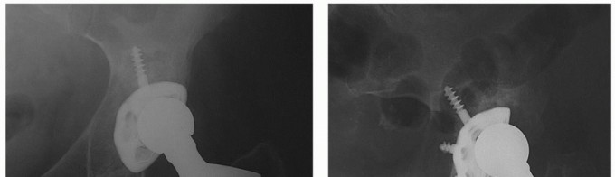 Osteolysis Solved: Polyethylene Liner Exchange for Well-Fixed Components