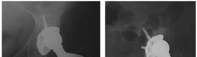 هشاشة العظام حول مفصل الورك الاصطناعي تبديل بطانة البولي إيثيلين الحل الأمثل