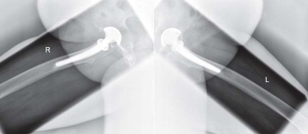 Illustration 82 for Collum Femoris Preserving: Achieve Better Primary Hip Outcomes