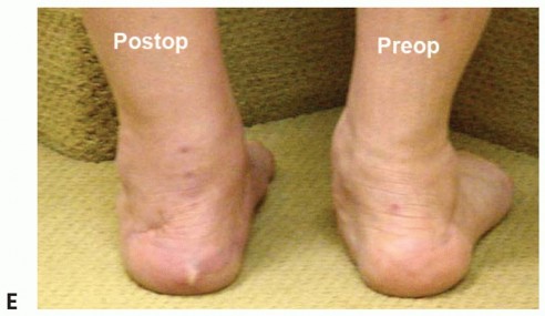 Illustration 29 for Lateral Column Lengthening: Relieve Flatfoot Pain & Correct Deformity