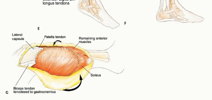 Illustration 29 for Beyond Amputation: The Type I Resection in Fibular Tumor Surgery