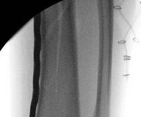 Illustration 29 for Tibial Fracture Extending into the Plafond: Intramedullary Secrets