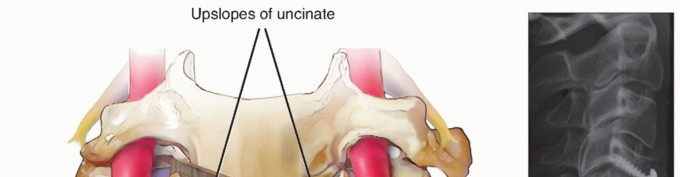 Illustration 10 for How ACDF Clears Your Posterior Disc Space for Lasting Relief