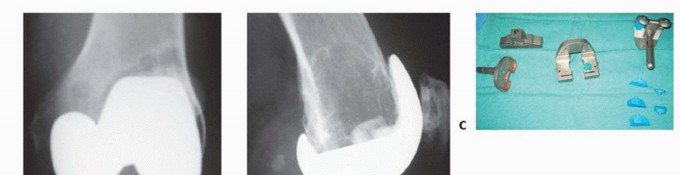 Illustration 7 for Femoral Bone Loss: Metal Augments for Revision Knee Success
