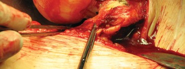 Illustration 35 for Figure Hip Resurfacing: Who Benefits and Who Should Avoid It?