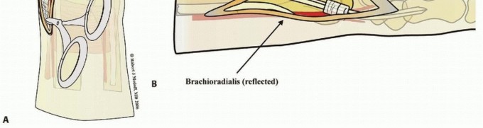 Illustration 15 for Fragment-Specific Fixation: Restore Carpal Facet Horizon