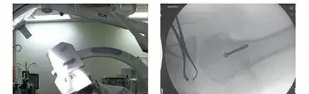 صورة توضيحية لـ جراحة الكسور الدقيقة: كيف يضمن التصوير المتقدم أفضل النتائج تحت إشراف الأستاذ الدكتور محمد هطيف