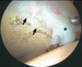 Illustration 31 for Solving Hip Soft Tissue Pathology with Advanced Arthroscopy