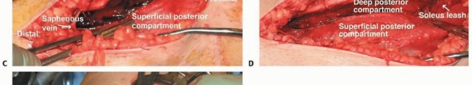 Illustration 18 for Acute Compartment Syndrome: Timely Fasciotomy Explained