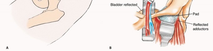 Illustration 24 for Pelvic Metastasis Surgery: A Component of the Utilitarian Approach
