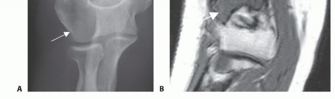 Illustration 5 for Distal Humeral Resection: Safe Techniques for Limb Preservation