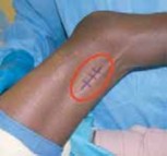 Illustration 10 for Unlocking Mobility: Distal Lengthening for Lateral Hamstring Muscle