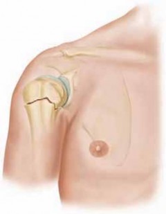 Illustration 10 for Mastering Pediatric Shoulder Fractures: Clinical Insights