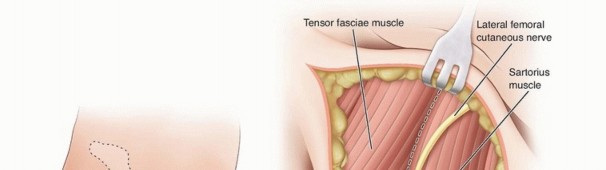 Illustration 10 for Septic Hip in Children: Mastering Anterior Drainage for Optimal Recovery