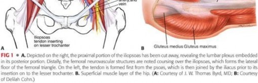 Illustration 11 for Stop the Snap: Hip Preservation for Snapping Iliopsoas Tendon