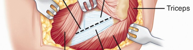 Illustration 28 for Radial Head Arthroplasty: Restoring Elbow Function & Stability