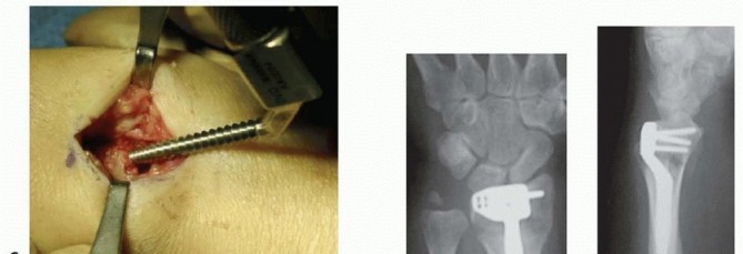 Illustration 21 for Distal Radius Fixation: Precision Through Lister's Tubercle