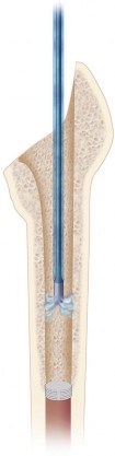 Illustration 20 for Cemented Femoral Stem Figures: Surgical Anatomy & Placement