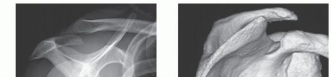 Illustration 8 for Solving Snapping Scapula: Is resection of the superomedial your option?