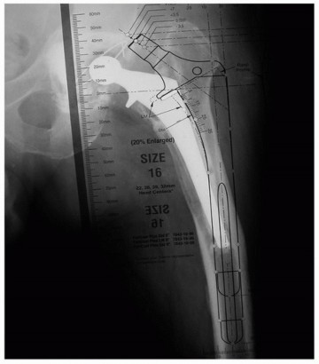 Illustration 10 for Revision THA: Why Extensively Porouscoated Cylindrical Stems Excel