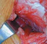 Illustration 22 for Cruciate Ligament Repair: Definitive Guide to Treatment & Recovery