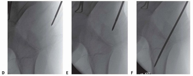Illustration 11 for Pediatric Femoral Nailing: Targeting the Right aspect of the greater Trochanter