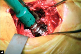 Illustration 39 for Optimizing Acetabular Component Cementation for Superior Outcomes