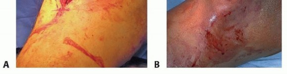 Illustration 24 for Advanced Nailing of the Mature Tibia: Overcoming Complexities