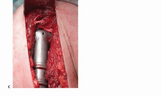 Illustration 33 for Restore Vital Function: Surgery for Type II Humeral Metastasis