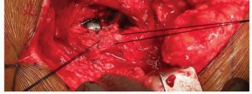 Illustration 13 for Uncemented Acetabular Revision: Optimizing Hemispherical Cup Use