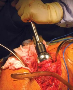 Illustration 68 for Metal on Metal Resurfacing: Enhanced Posterior Soft Tissue Repair