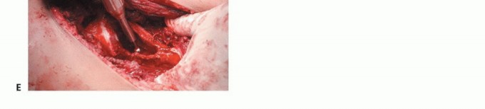 Illustration 41 for Pelvic Metastasis Surgery: A Component of the Utilitarian Approach