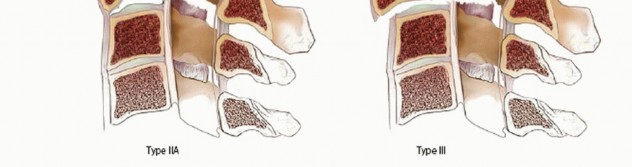 Illustration 18 for Master Techniques for Cervical Fracture Reduction: Type III & More